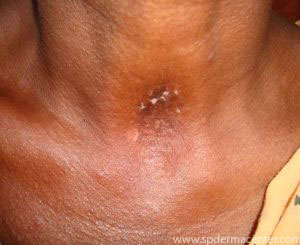 Vitiligo-Treated
